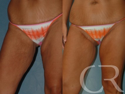 https://www.kyplastics.com/webres/Image/female/body/thigh-lift/thigh-lift-1.jpg